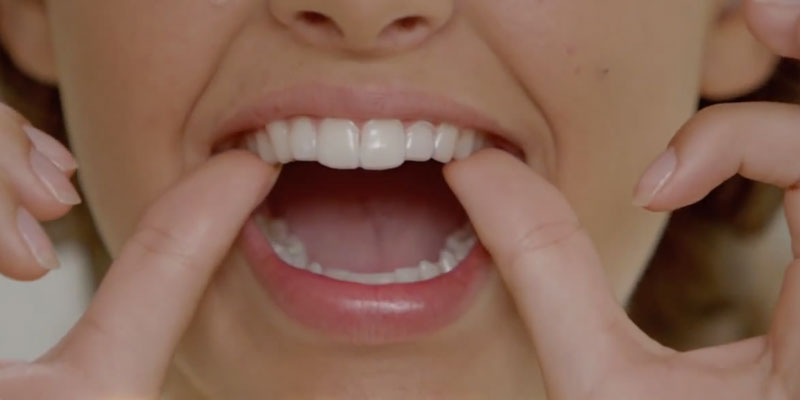 Philips Zoom NiteWhite Teeth Whitening application